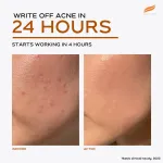 Himalaya Acne Clear+ Spot Treatment Pen with 2% Natural Salicylic Acid Reducing Acne Size in 24 hrs view 9