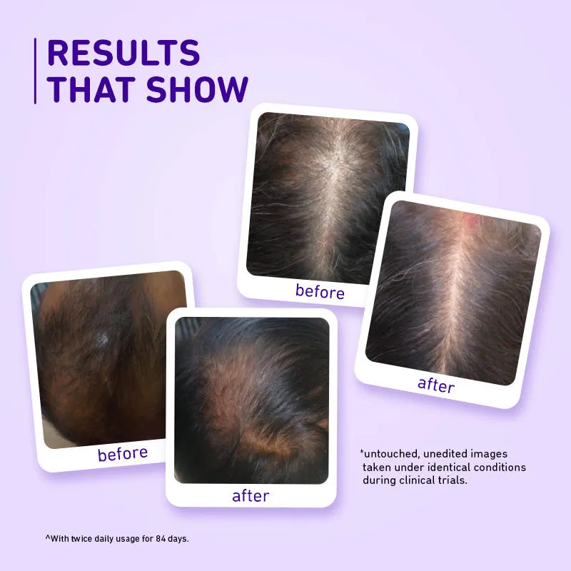 Plum Rosemary & 3% Redensyl Hair Growth Serum