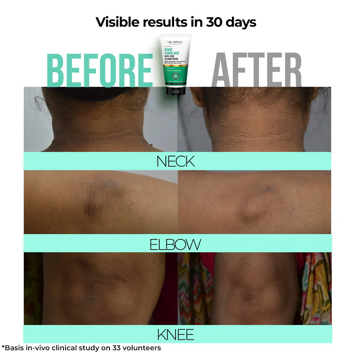 Dr. Sheth's Kesar & Kojic Acid Neck, Knee & Elbow Cream