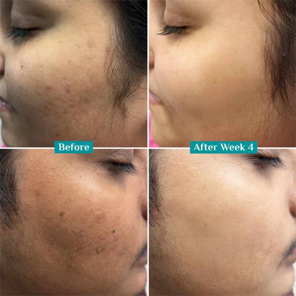 Pilgrim 10% Vitamin C Face Serum Triple Glow+++ with 5%Niacinamide Brightens All Skin Type Pack of 3