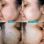 Pilgrim Salicylic & Glycolic Acid Anti Acne Serum view 6